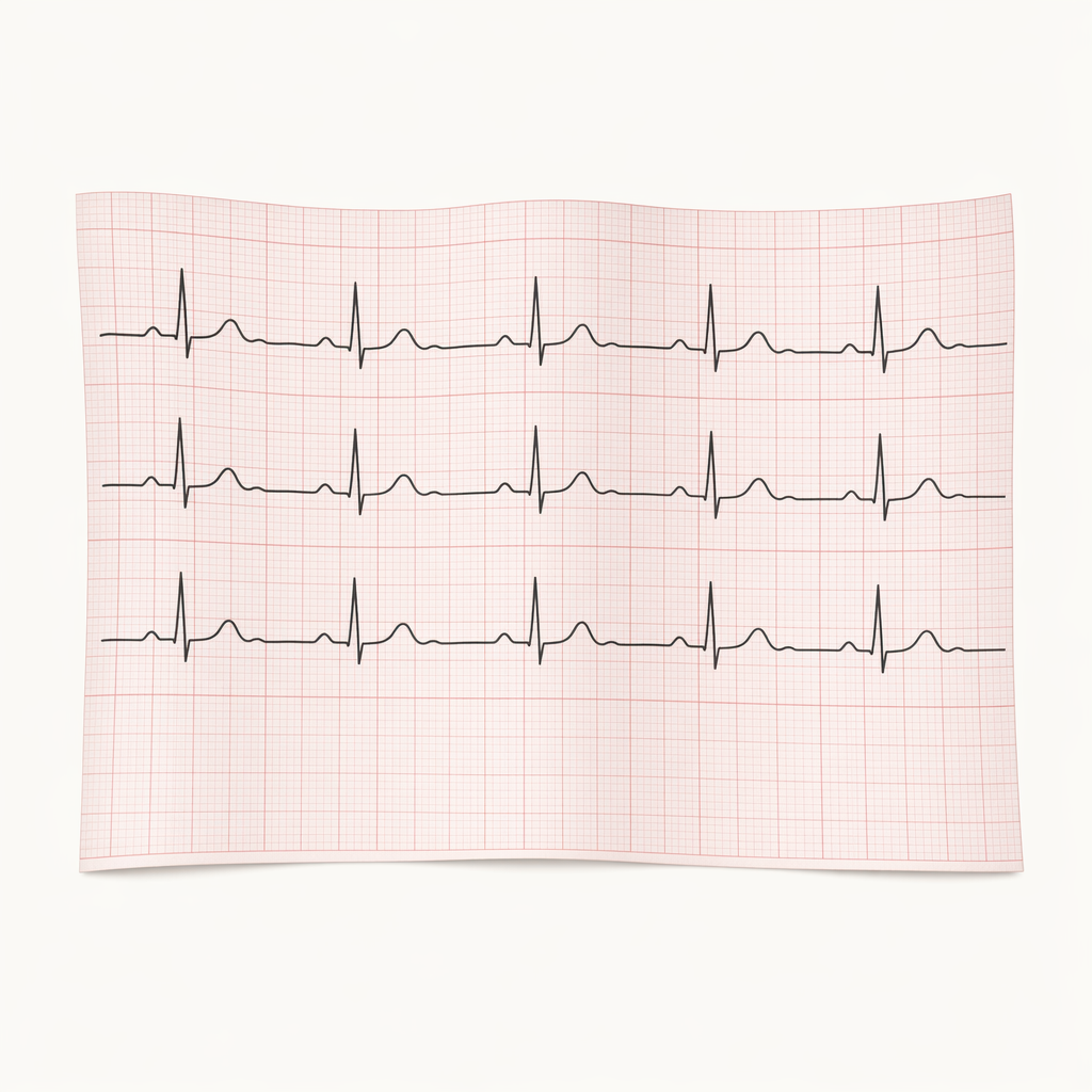 EKG