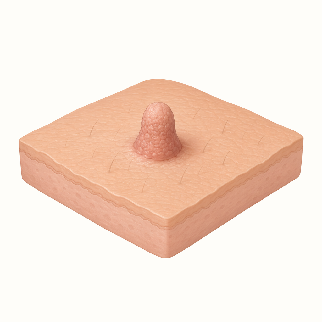 papilloma